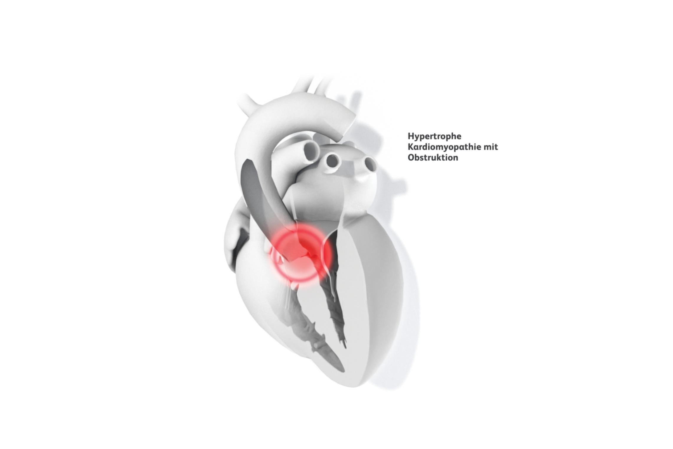 medizinische Illustration Herzen mit hypertropher Kardiomyopathie mit Obstruktion