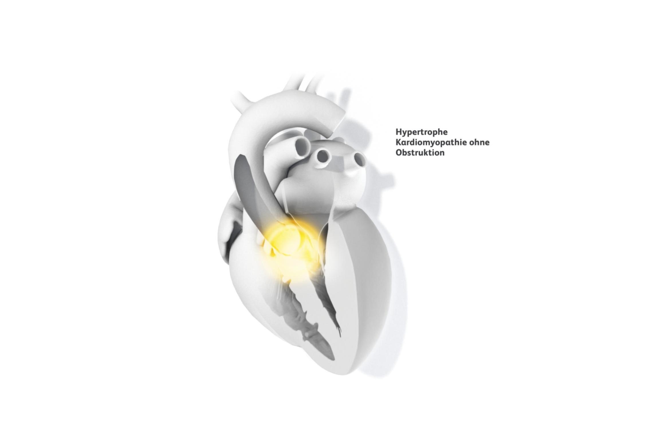 medizinische Illustration Herzen mit hypertropher Kardiomyopathie ohne Obstruktion