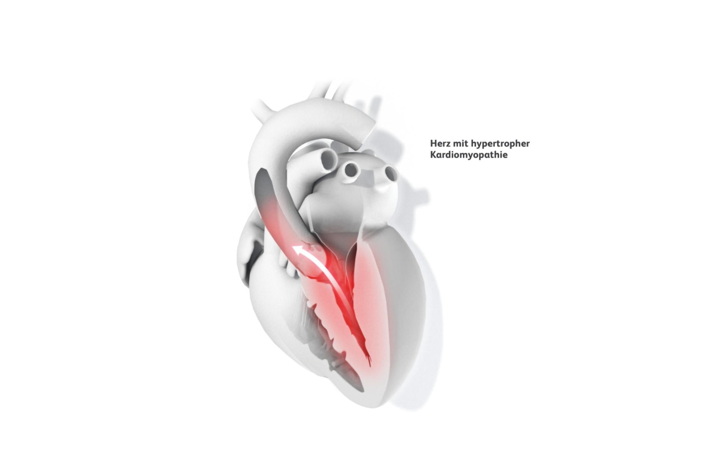 medizinische Illustration eines Herzens mit hypertropher Kardiomyopathie