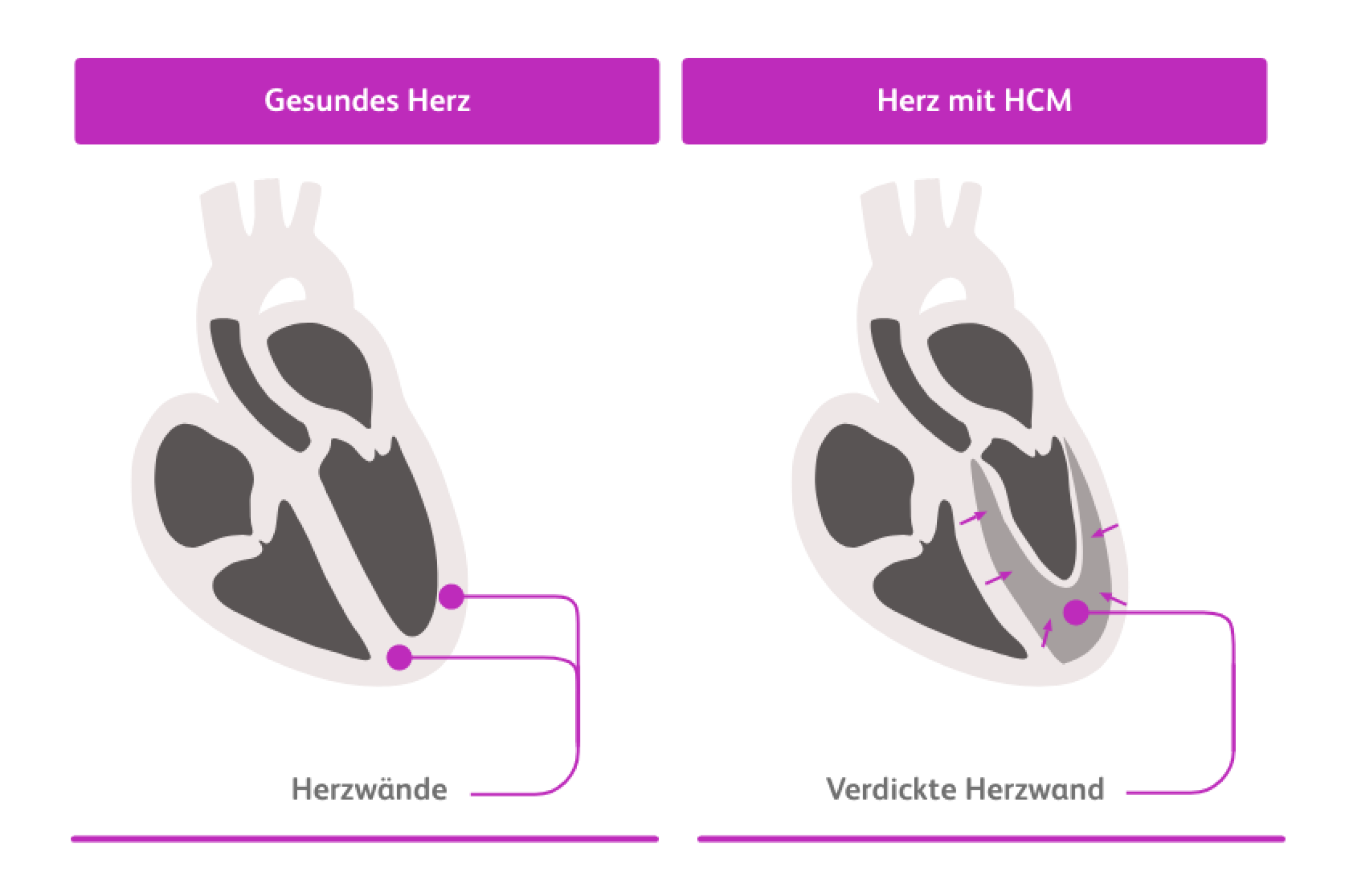 Schematische Darstellung – Vergleich gesundes Herz und Herz mit HCM