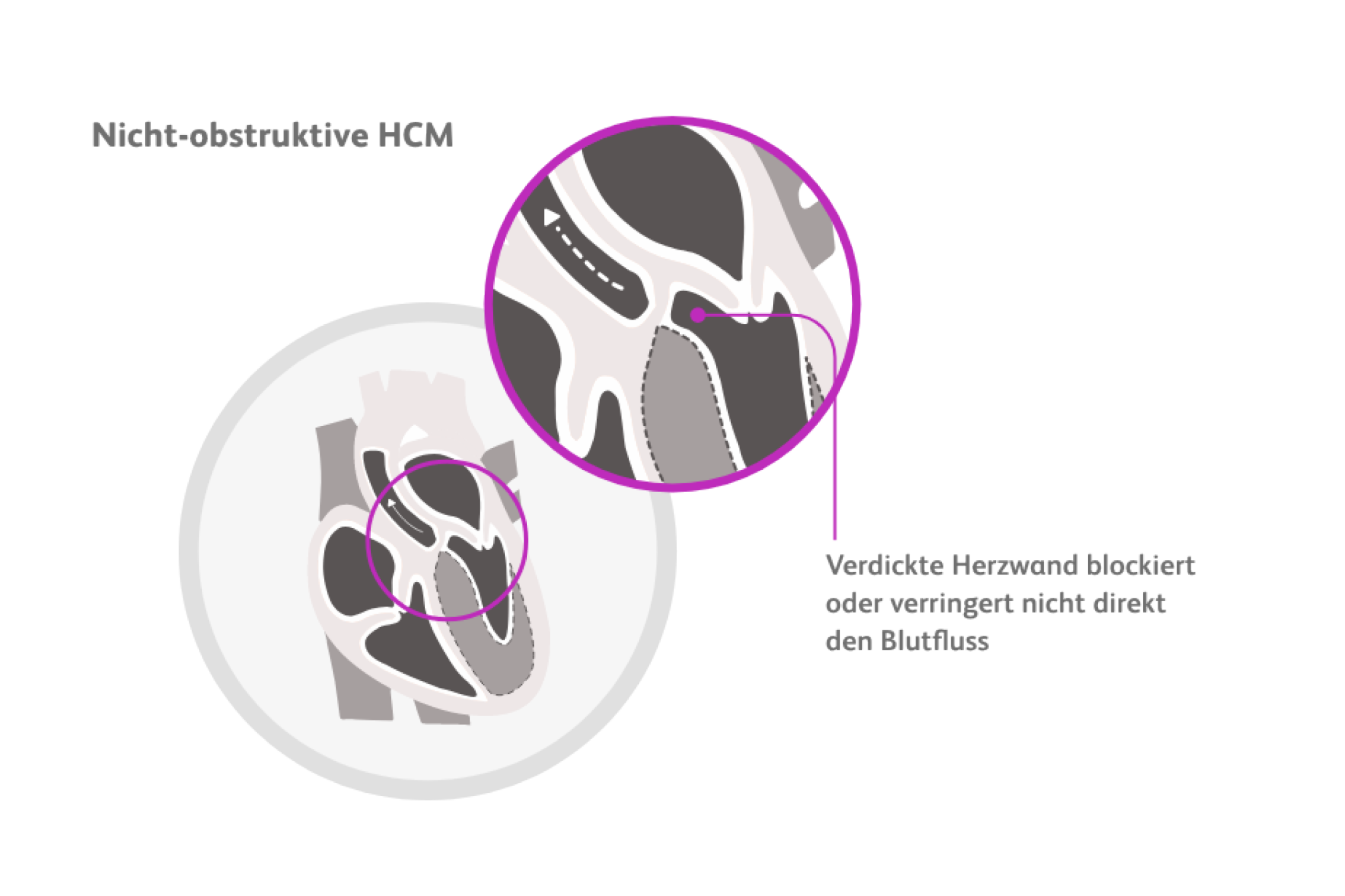 medizinische Illustration einer Nicht-obstruktiven HCM