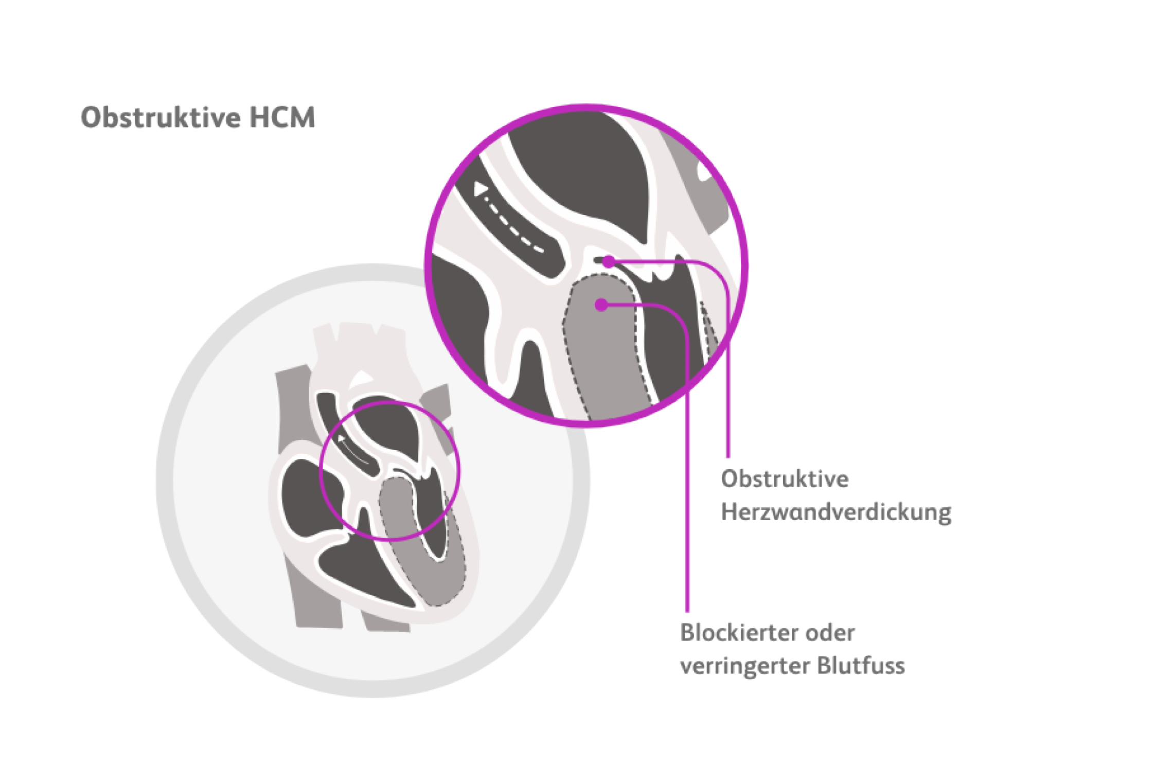 medizinische Illustration einer Obstruktiven HCM